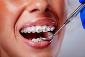 Orthodontics Dentreat
